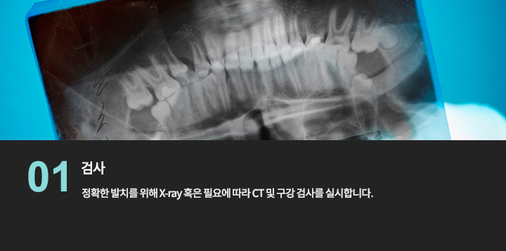 -검사
정확한 발치를 위해 X-ray 혹은 필요에 따라 CT 및 구강 검사를 실시합니다.
