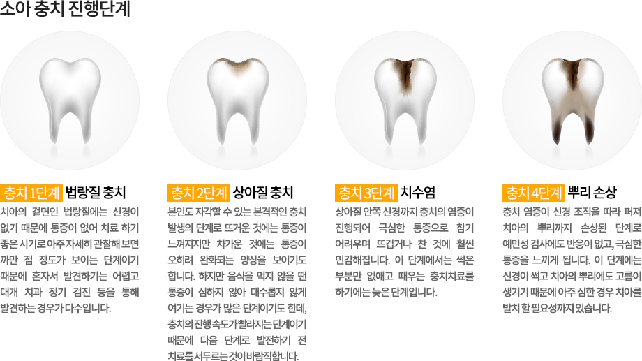 소아 충치 진행단계
-충치 1단계 : 법랑질 충치
치아의 겉면인 법랑질에는 신경이 없기 때문에 통증이 없어 치료 하기 좋은 시기로 아주 자세히 관찰해 보면 까만 점 정도가 보이는 단계이기 때문에 혼자서 발견하기는 어렵고 대개 치과 정기 검진 등을 통해 발견하는 경우가 다수입니다.
-충치 2단계 : 상아질 충치
본인도 자각할 수 있는 본격적인 충치 발생의 단계로 뜨거운 것에는 통증이 느껴지지만 차가운 것에는 통증이 오히려 완화되는 양상을 보이기도 합니다. 하지만 음식을 먹지 않을 땐 통증이 심하지 않아 대수롭지 않게 여기는 경우가 많은 단계이기도 한데, 충치의 진행 속도가 빨라지는 단계이기 때문에 다음 단계로 발전하기 전 치료를 서두르는 것이 바람직합니다.
-충치 3단계 : 치수염 
상아질 안쪽 신경까지 충치의 염증이 진행되어 극심한 통증으로 참기 어려우며 뜨겁거나 찬 것에 훨씬 민감해집니다. 이 단계에서는 썩은 부분만 없애고 때우는 충치치료를 하기에는 늦은 단계입니다.
-충치 4단계 : 뿌리 손상
충치 염증이 신경 조직을 따라 퍼져 치아의 뿌리까지 손상된 단계로 예민성 검사에도 반응이 없고, 극심한 통증을 느끼게 됩니다. 이 단계에는 신경이 썩고 치아의 뿌리에도 고름이 생기기 때문에 아주 심한 경우 치아를 발치 할 필요성까지 있습니다.